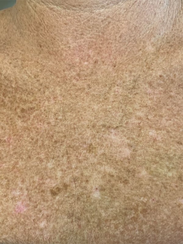 Sciton BBL HERO Before & After Image