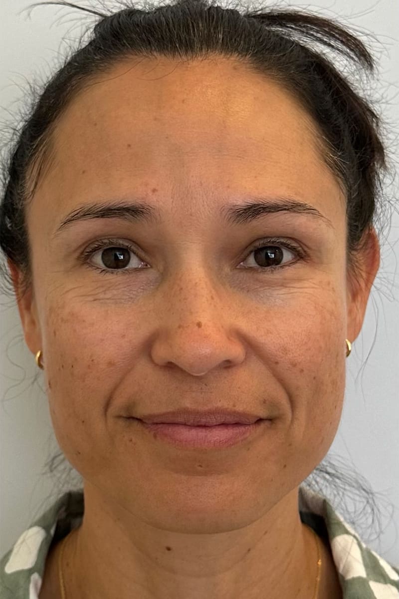 VI Peel Before & After Image