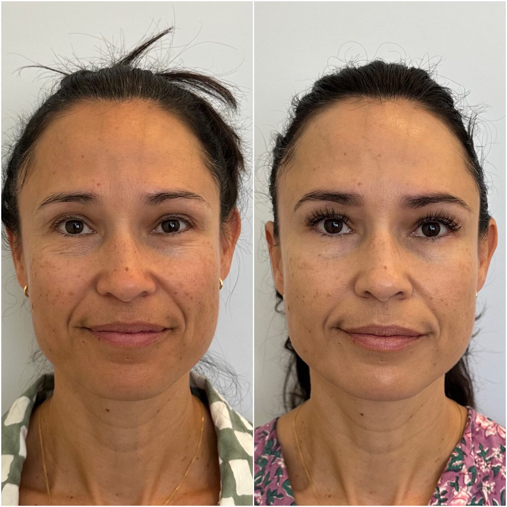 Neurotoxin, VI Peel, Lash Extensions