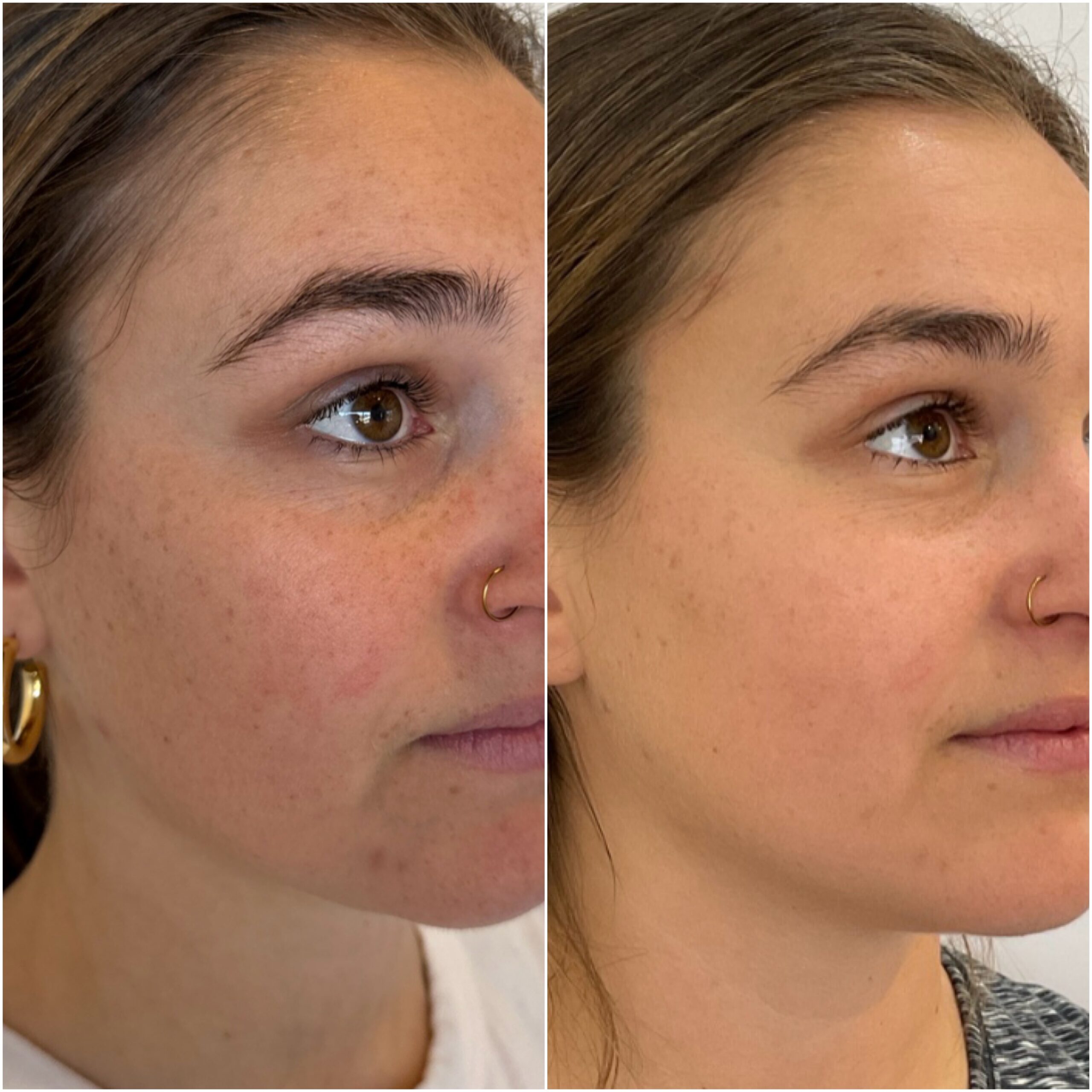 BBL laser treatment results - before and after close up of right side of the face