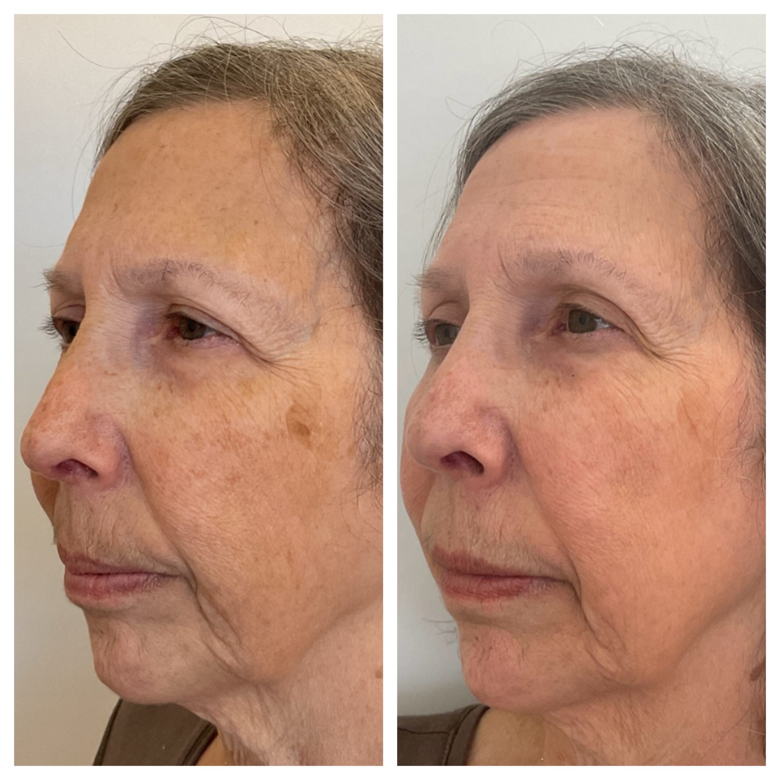 BBL laser treatment results - before and after close up of left side of the face
