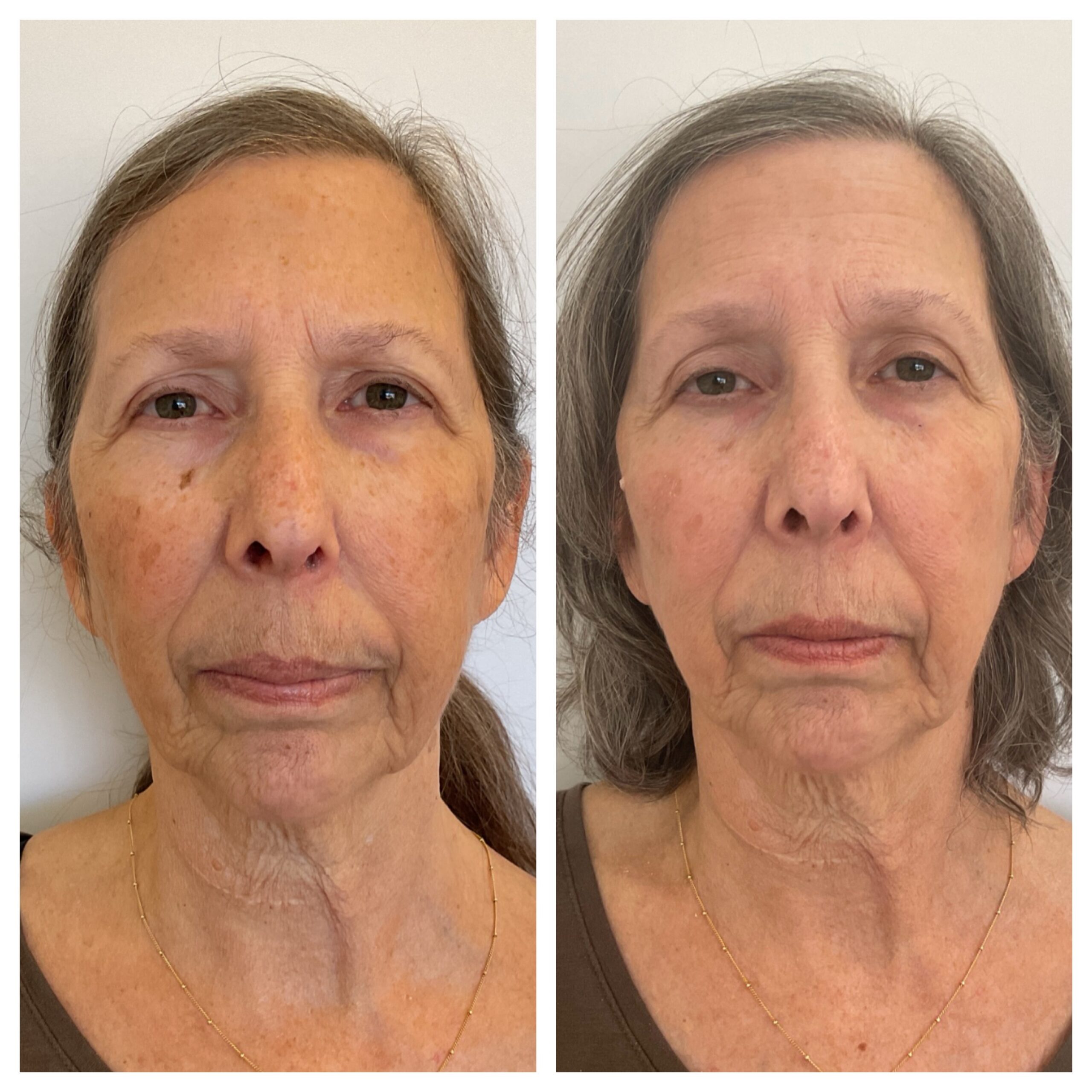 BBL laser treatment results - before and after close up of face