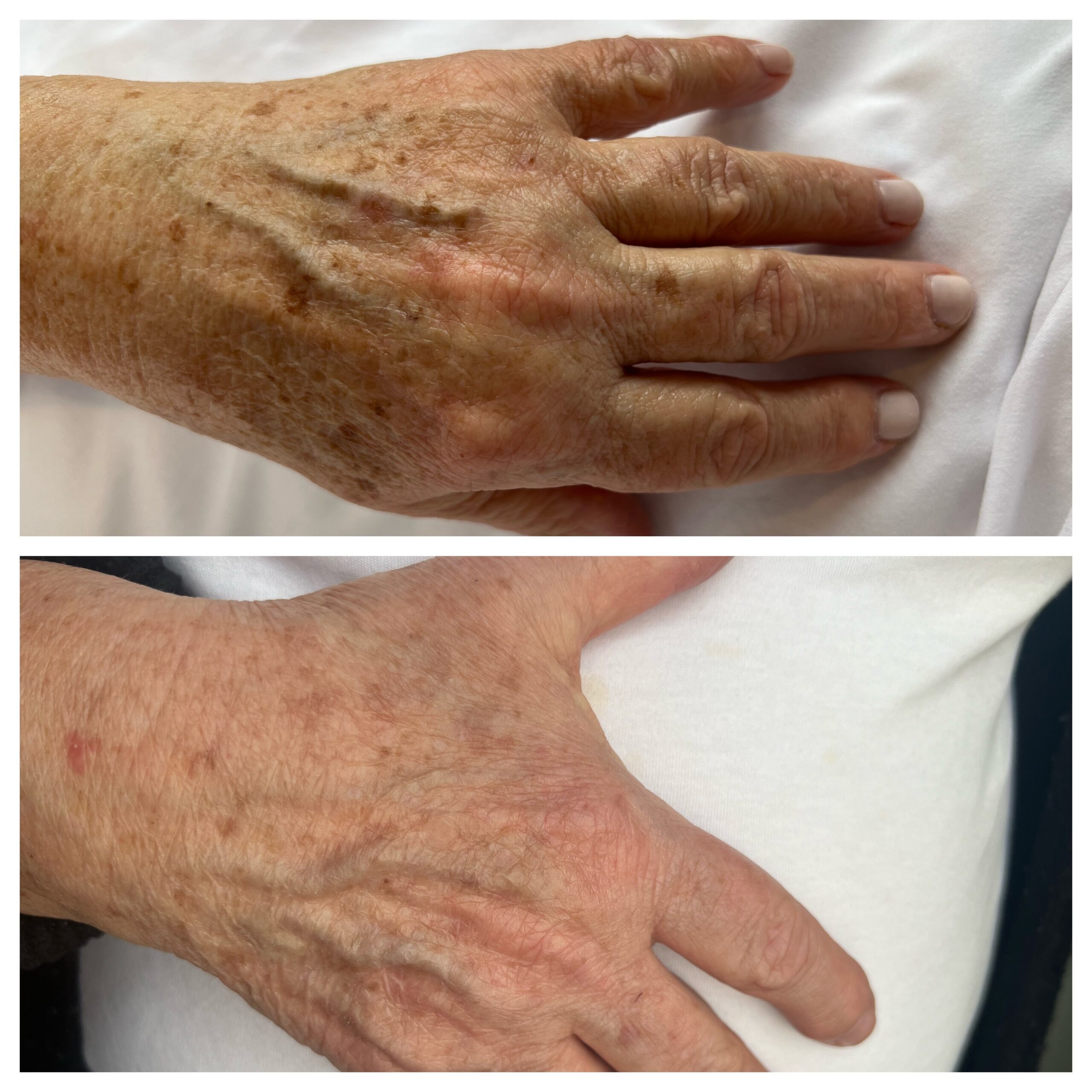 Laser skin treatment BBL and Moxi - before and after close up of hands