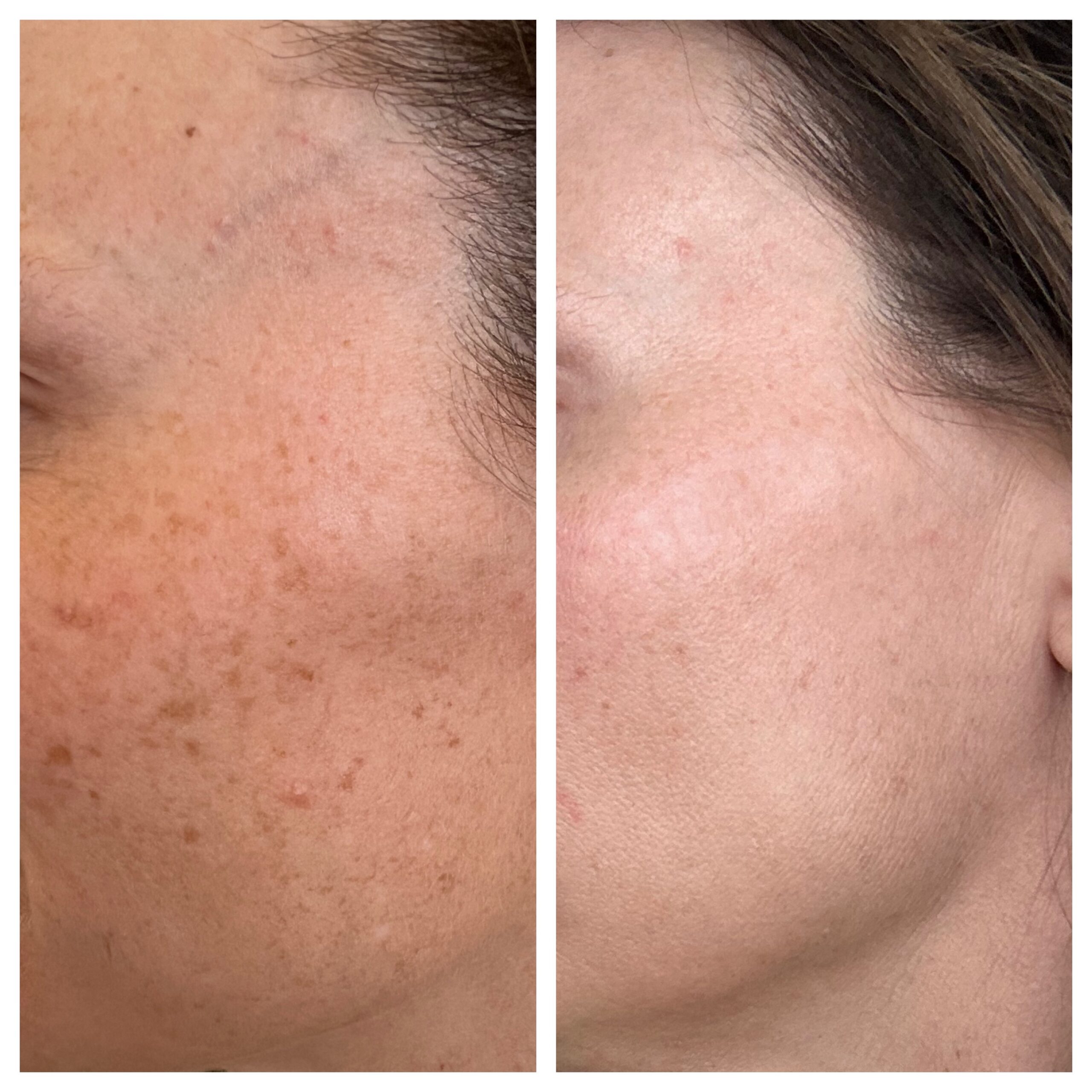 Laser skin treatment BBL and Moxi - before and after close up