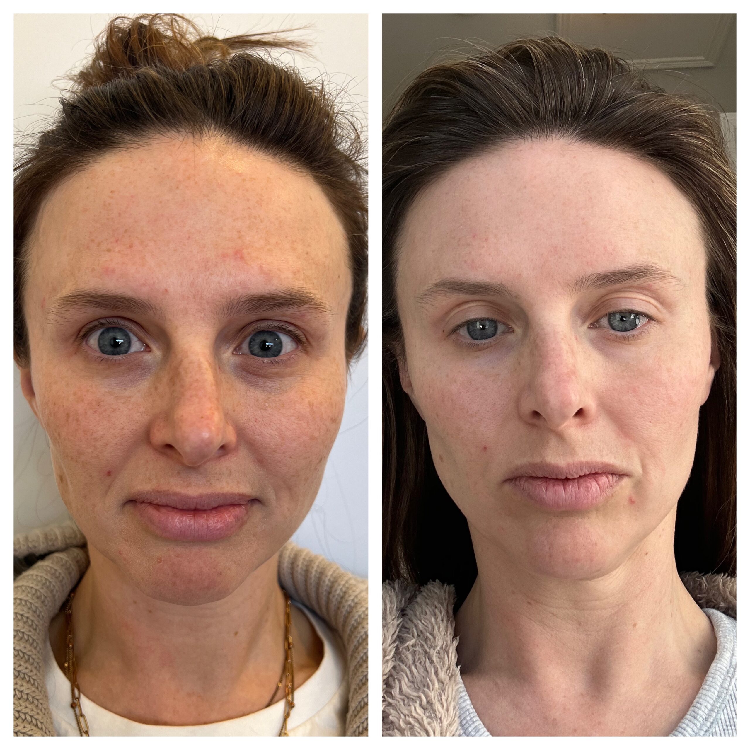Laser skin treatment BBL and Moxi - Before and after of woman's face