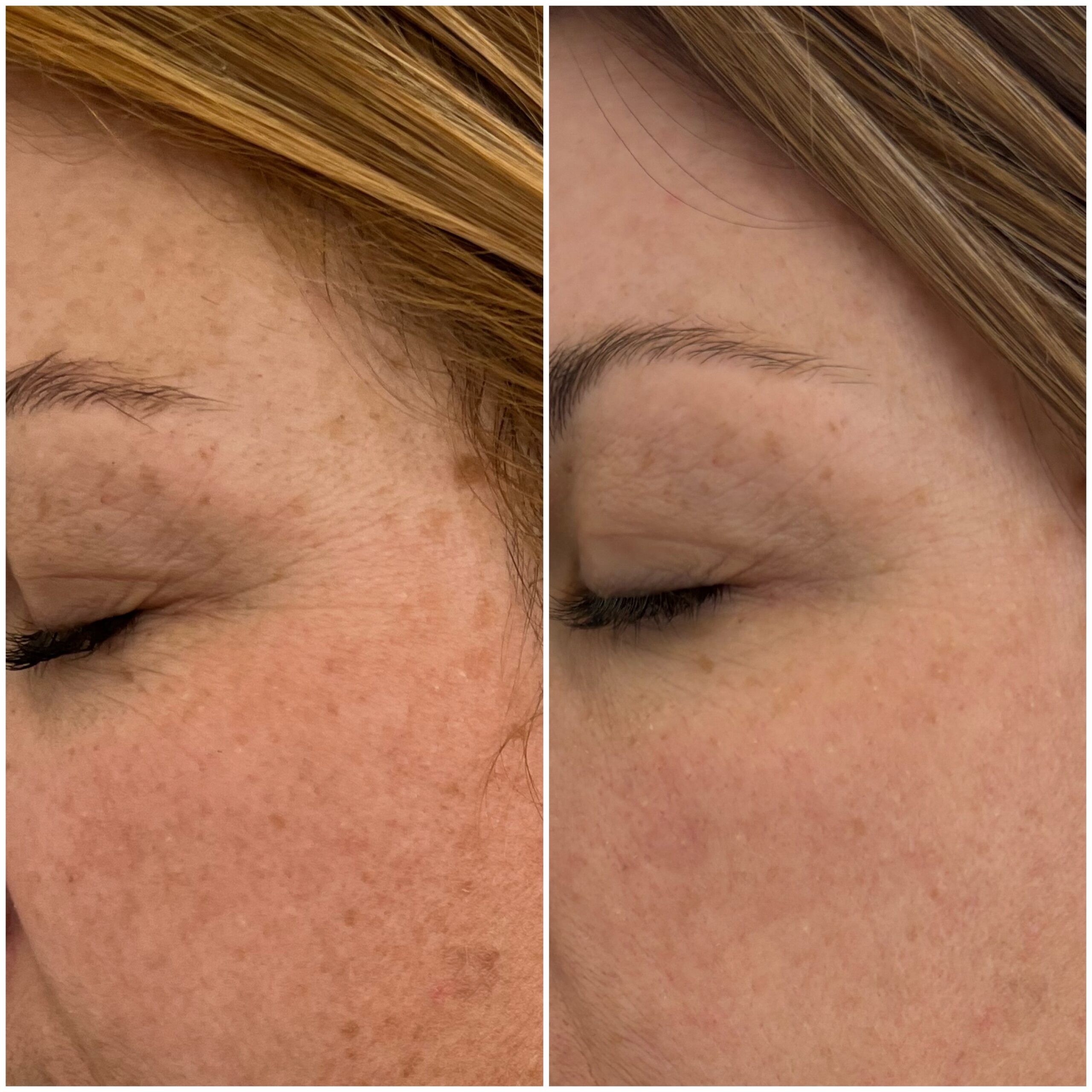 Moxi laser treatment results from client - before and after close up of eye area