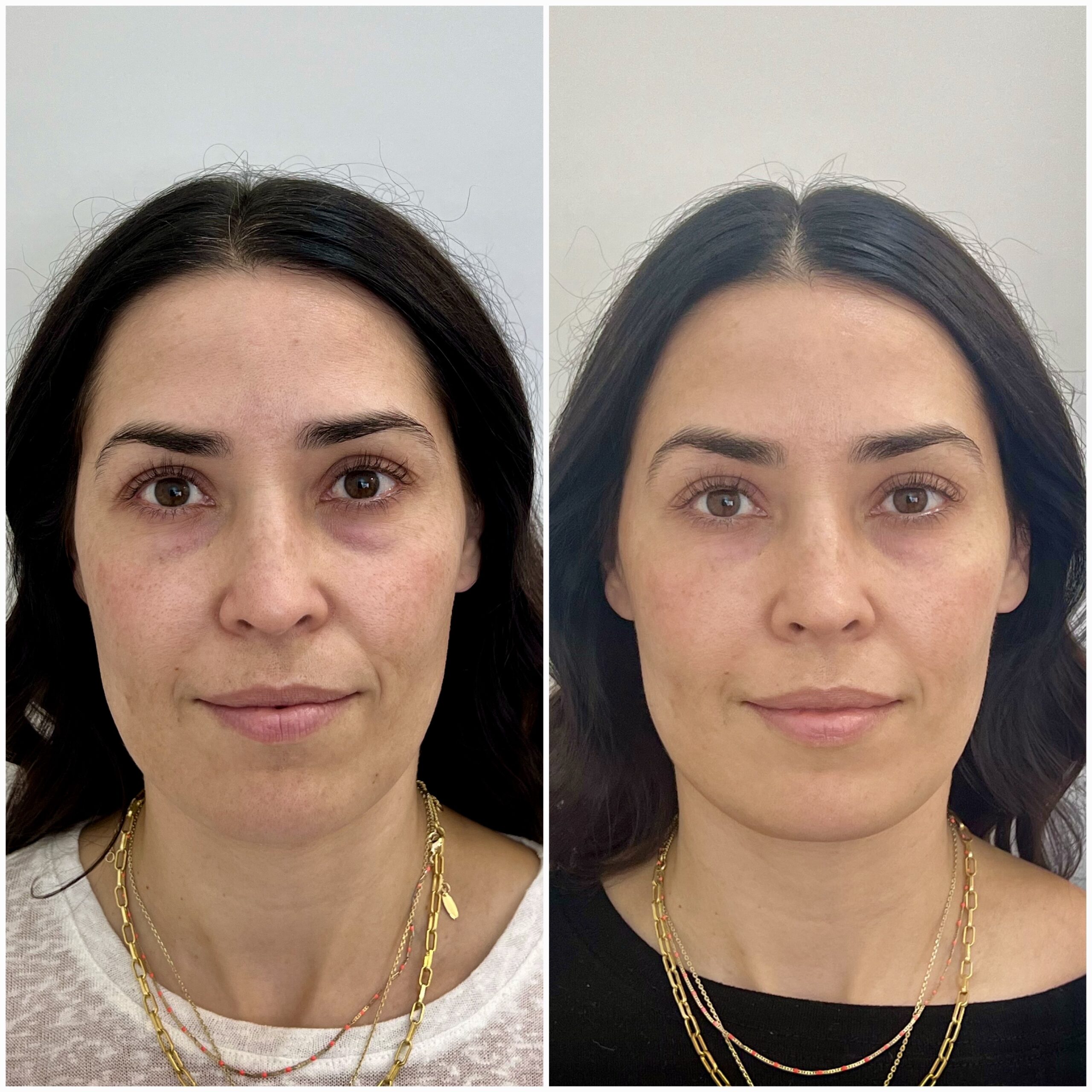 PRF EZ Gel before and after photo