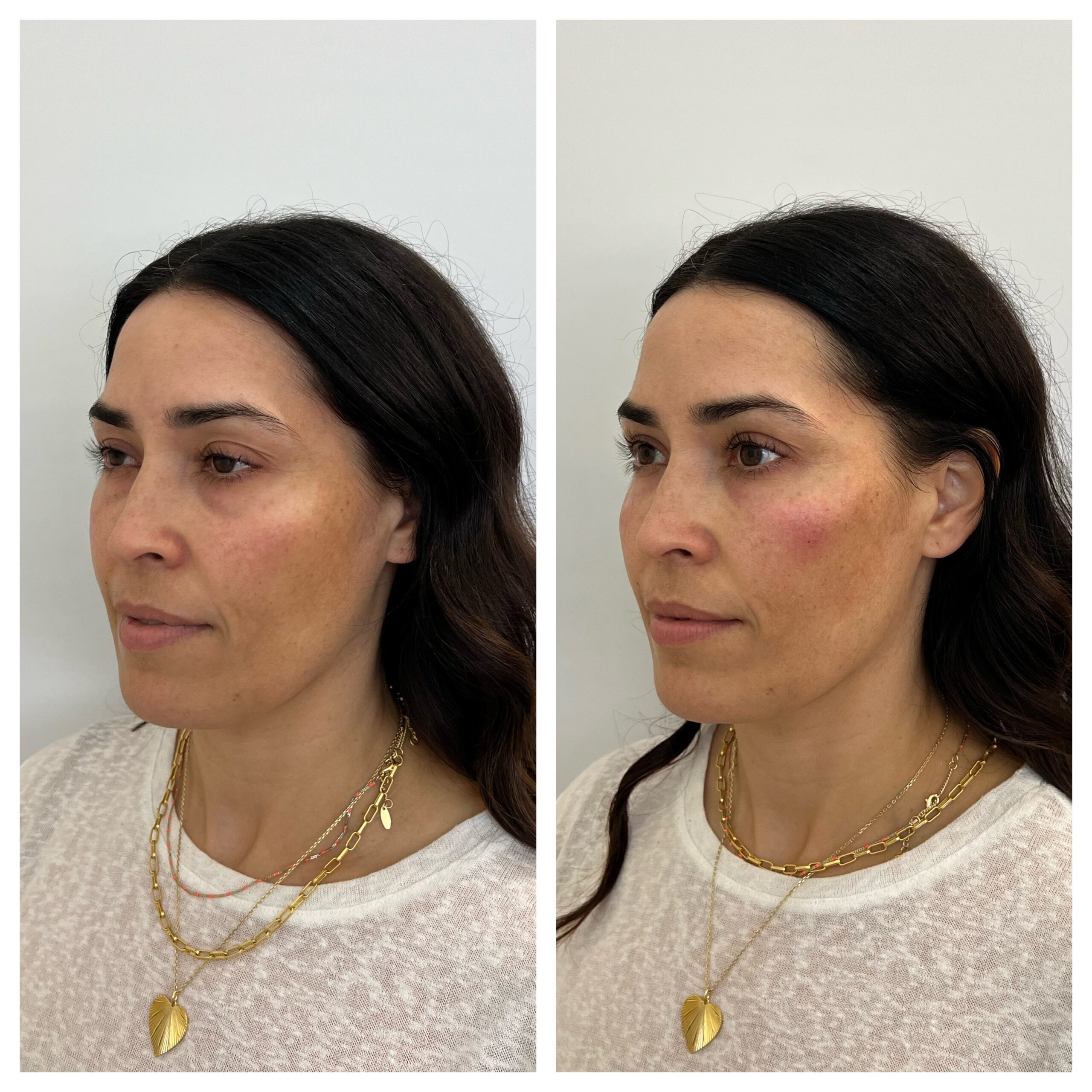 PRF EZ Gel before and after photo from left side