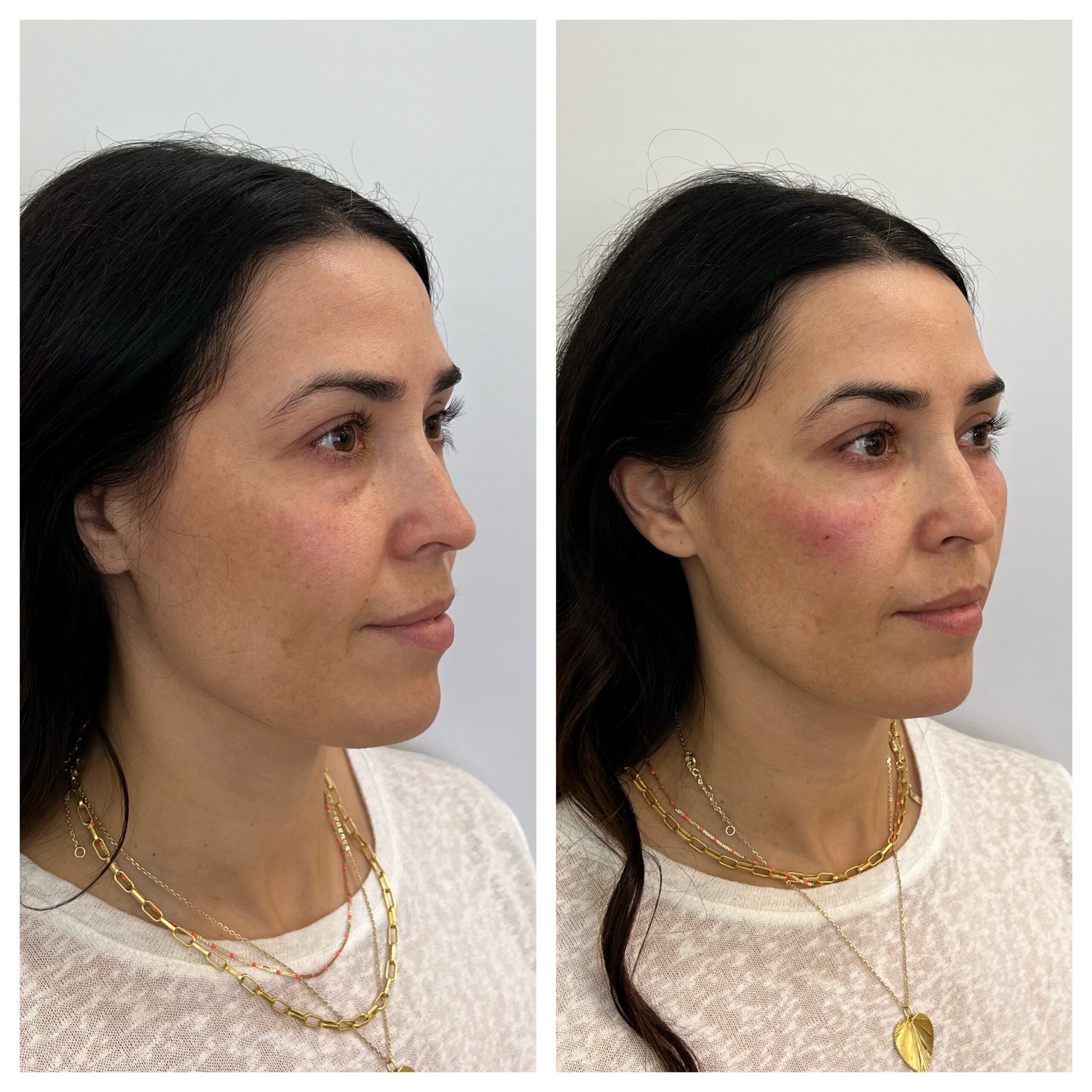 PRF EZ Gel before and after photo from right side