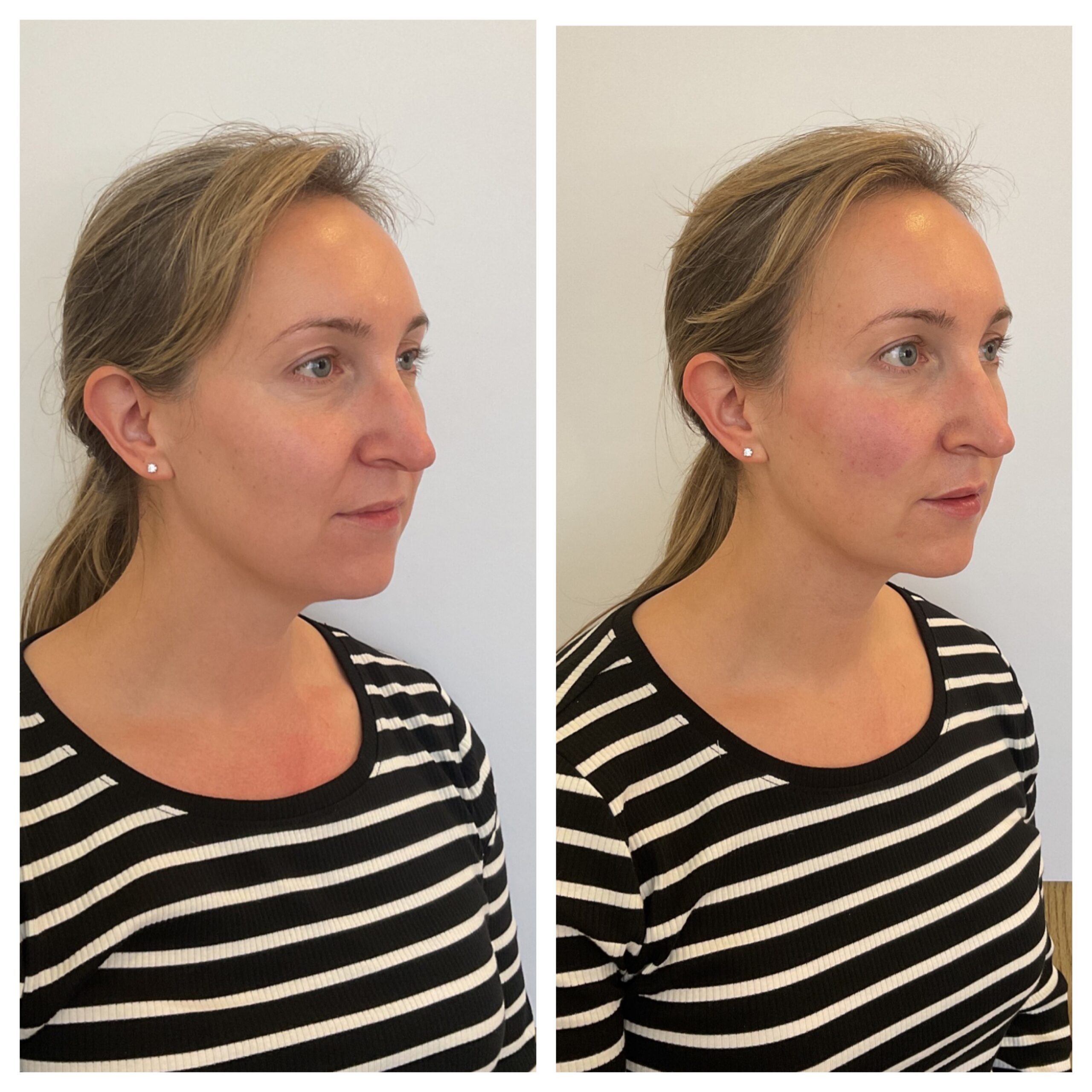 Facial Filler