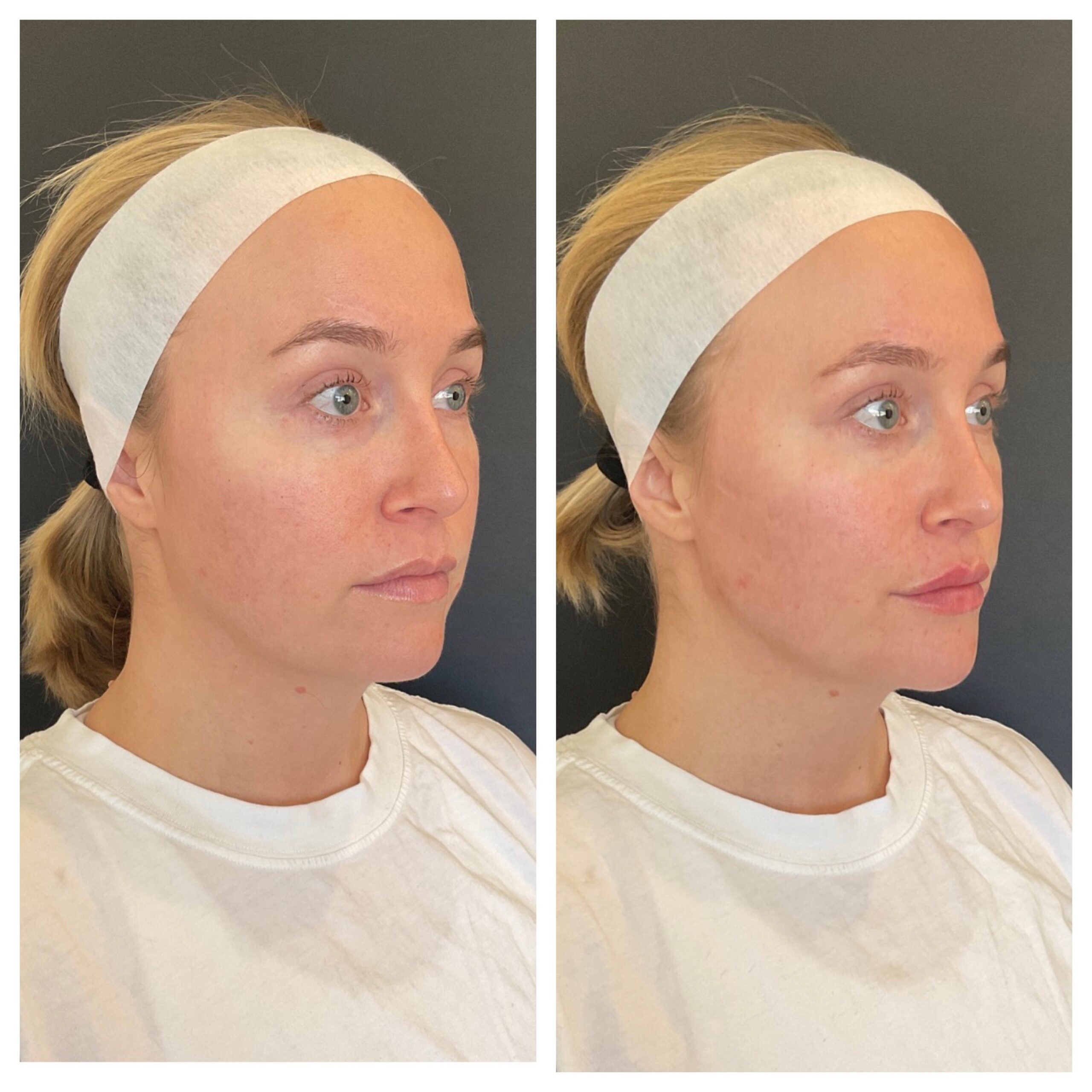 Full Face Filler