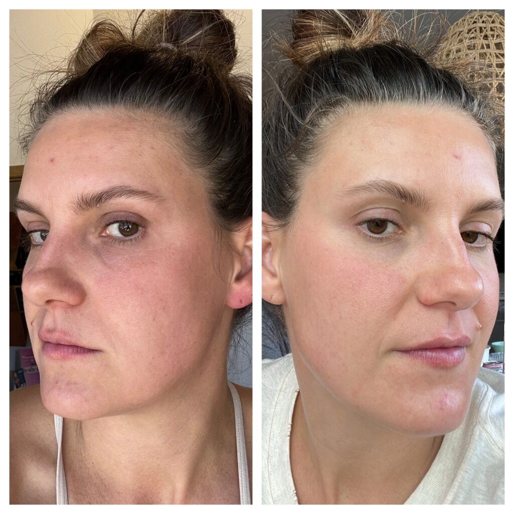 HydraFacial before and after