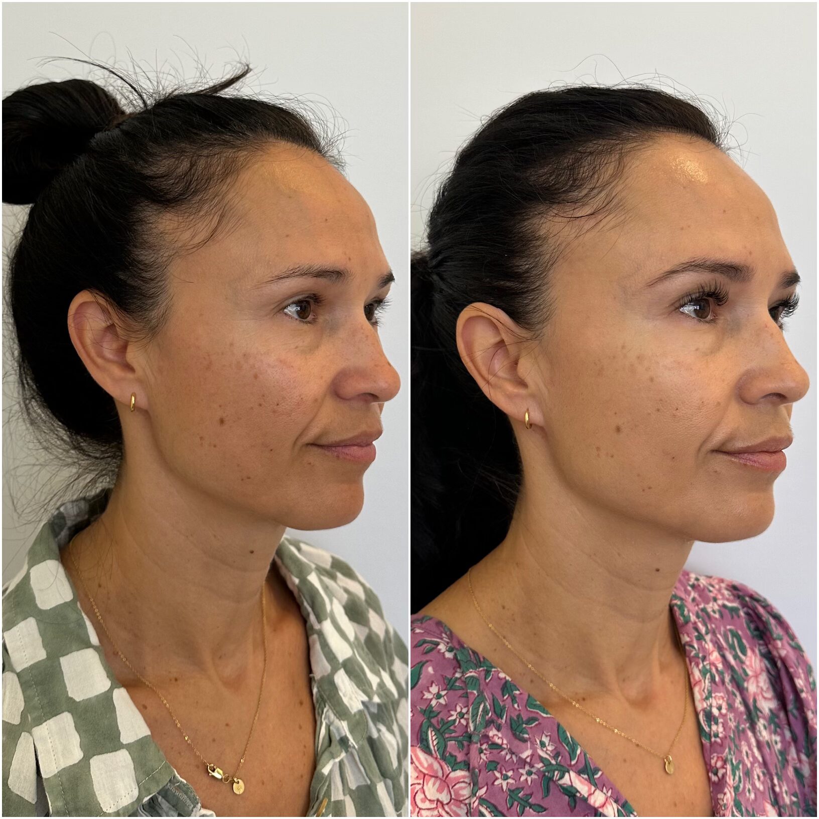 Botox