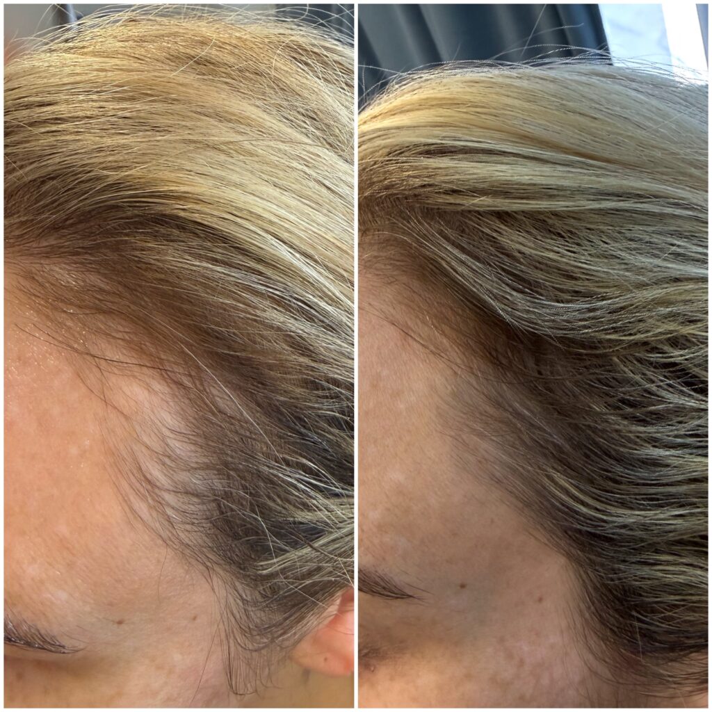 Hair Restoration, PRF Injections